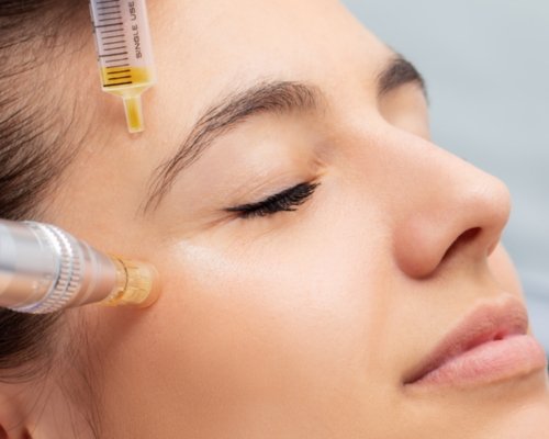 PRP & Microneedling in Roorkee